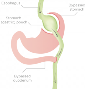 Gastric Bypass Bariatric Weight Loss Surgery Houston Tx Gastric Bypass Bariatric Weight Loss Surgery Houston Tx