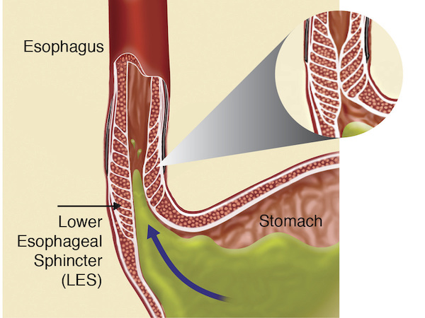 gerd gastroesophageal reflux disease