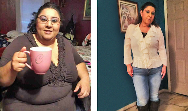 TLCSurgery_before_after_Andreana_Website_v2