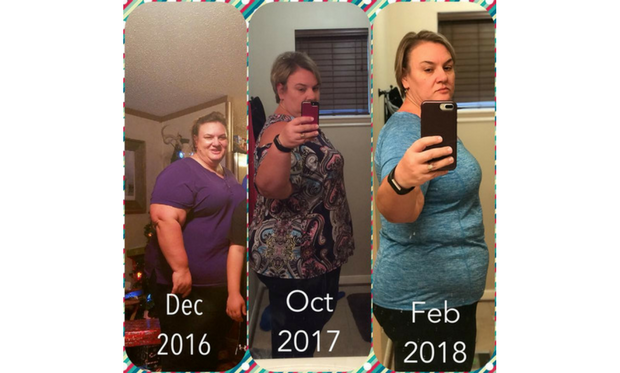 weight loss surgery success story